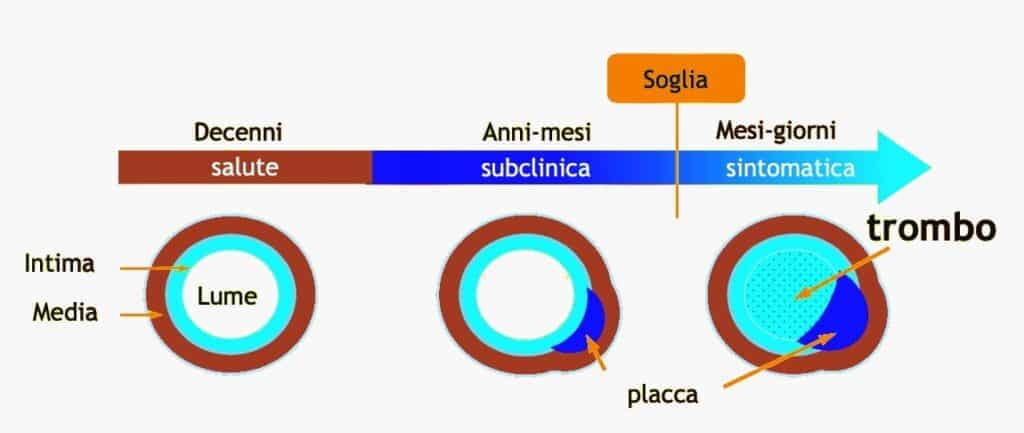 Aterosclerosi: cause, cure, esami, test clinico 4 Aterosclerosi caue sintomi - da subclinica a sintomatica