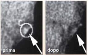 Aterosclerosi: cause, cure, esami, test clinico 7 Ateroscelrsosi: documentata scomparsa delle placche