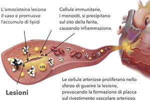 Omocisteina alta cause, conseguenze, terapia 6 Omocisteina effetti sui vasi sanguigni