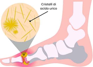 Gotta: sintomi, cause, dieta, rimedi naturali 3 gotta piede sintomi