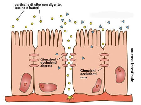 Anemia e carenza di ferro: sintomi, cause, esami e rimedi 5 Permeabilità intestinale anemia e carenza di ferro