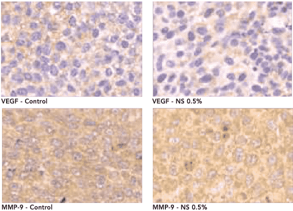Immunoistochimica di xenotrapianti di fibrosarcoma umano